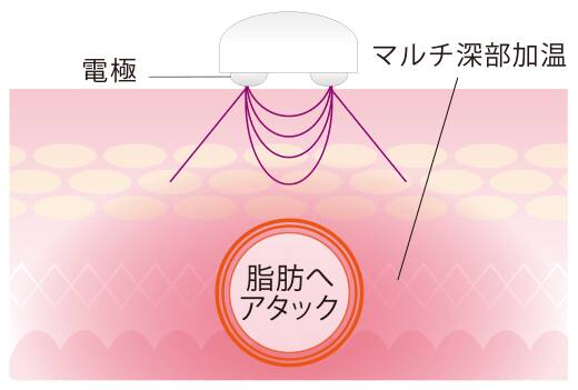 RF波が深部を加温し脂肪へアタック