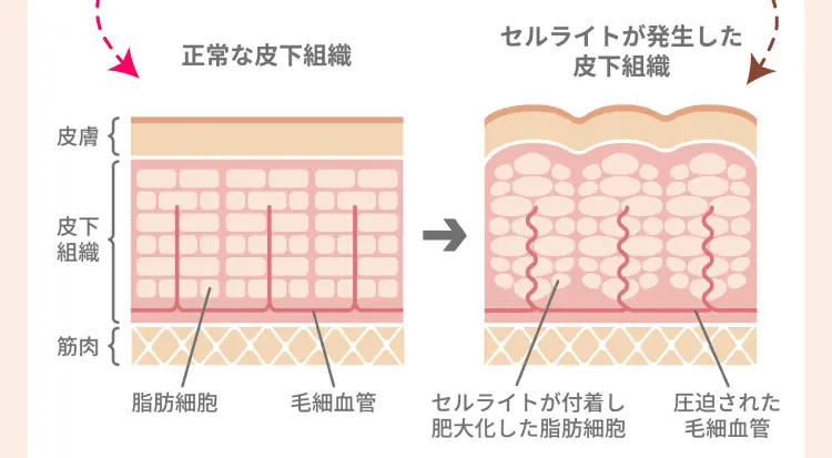 
    正常な皮下組織とセルライトが発生した皮下組織の断面図。こんなにもセルライトの影響が！
