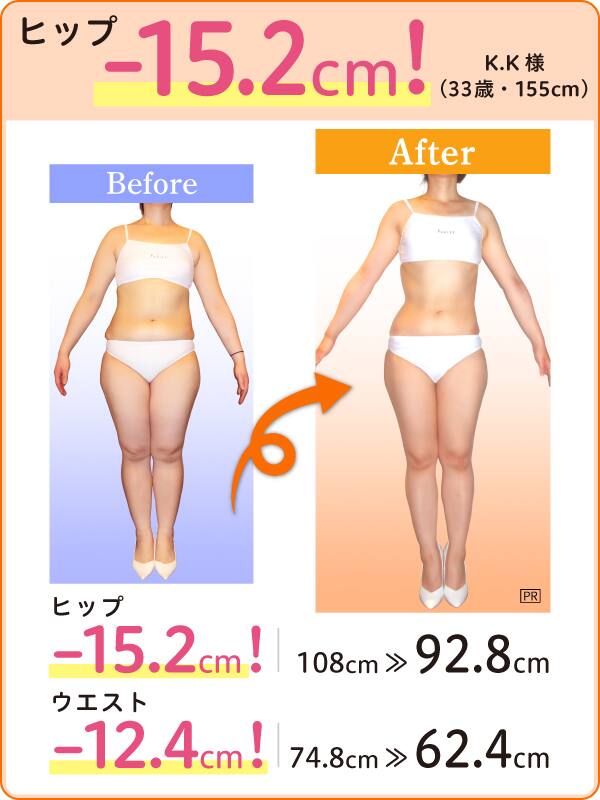 ヒップ -15.2cm！ K.K様（33歳・155cm）Before-After ヒップ -15.2cm！ 108cm → 92.8cm ウエスト -12.4cm！ 74.8cm → 62.4cm
