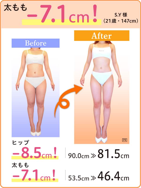 太もも -7.1cm！ S.Y様（21歳・147cm）Before-After ヒップ -8.5cm！ 90.0cm → 81.5cm 太もも -7.1cm！ 53.5cm → 46.4cm