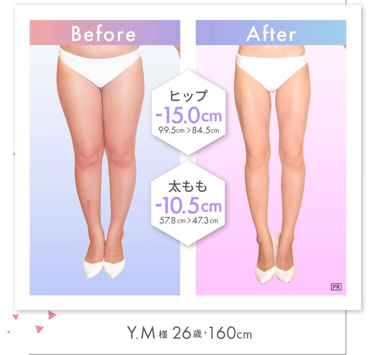 太もも -9.8cm！ Y.M様（26歳・160cm）
Before-After ヒップ -15.0cm！ 99.5cm → 84.5cm 太もも -10.5cm！ 57.8cm → 47.3cm