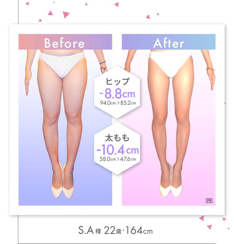 太もも -10.4cm！ S.A様（22歳・164cm）
Before-After ヒップ -8.8cm！ 94.0cm → 85.2cm 太もも -10.4cm！ 58.0cm → 47.6cm