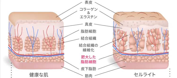 健康な肌とセルライト肌の比較図 肥大した脂肪細胞が表皮を押し上げボコボコに