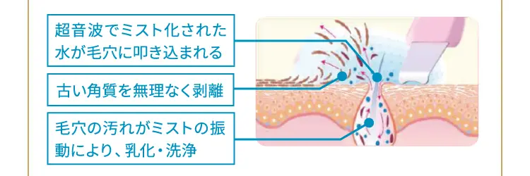 超音波でミスト化された水が毛穴に叩き込まれる
        古い角質を無理なく剥離
        毛穴の汚れがミストの振動により、乳化・洗浄