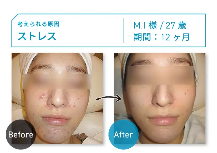 CASE01 考えられる原因：ストレス M.I様 27歳 期間：約12ヶ月 Before-After