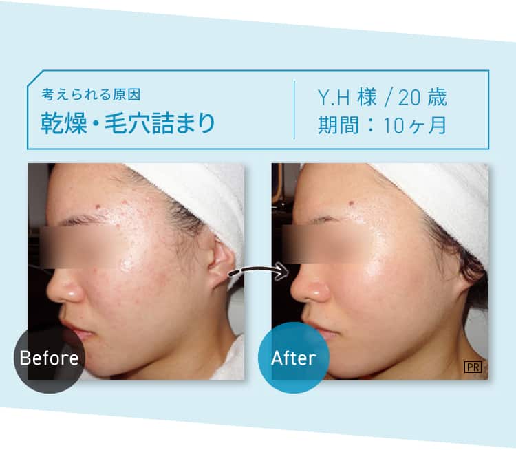 CASE02 考えられる原因：乾燥・毛穴づまり Y.H様 20歳 期間：約10ヶ月 Before-After