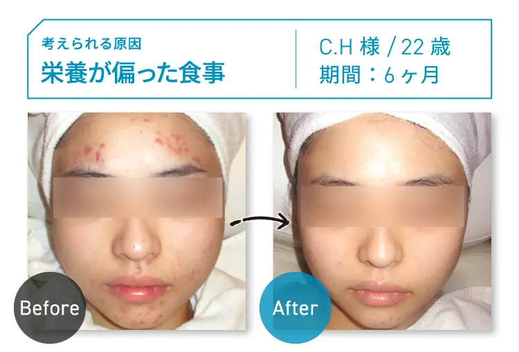 CASE03 考えられる原因：栄養が偏った食事 C.H様 22歳 期間：約6ヶ月 Before-After