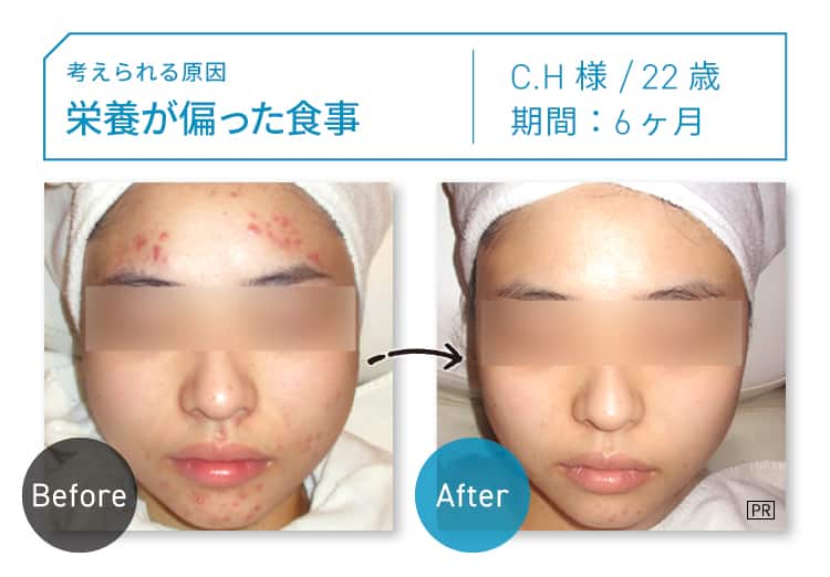 CASE03 考えられる原因：栄養が偏った食事 C.H様 22歳 期間：約6ヶ月 Before-After