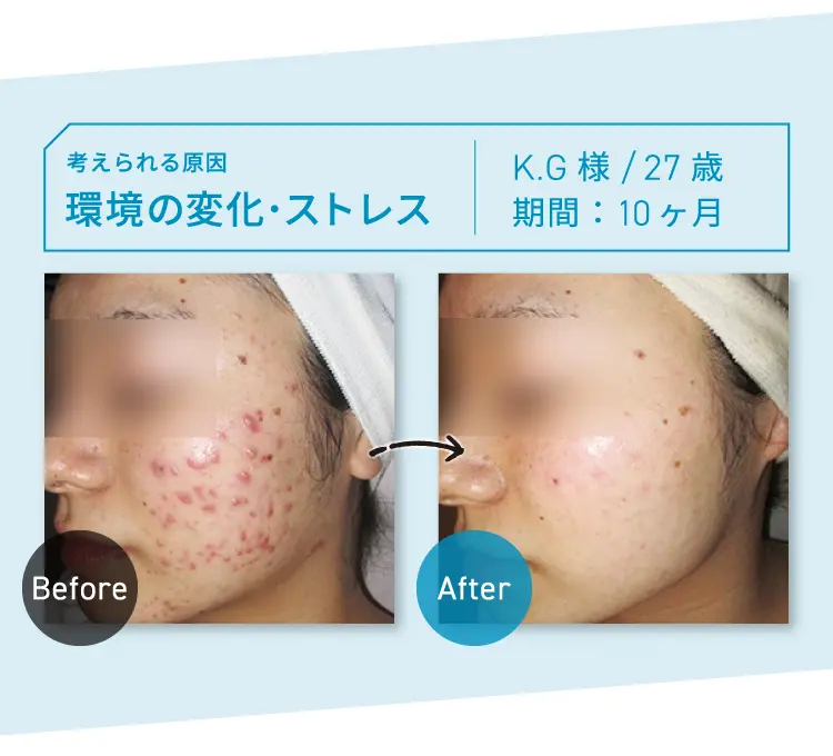 CASE04 考えられる原因：環境の変化・ストレス M.S様 22歳 期間：約18ヶ月 Before-After