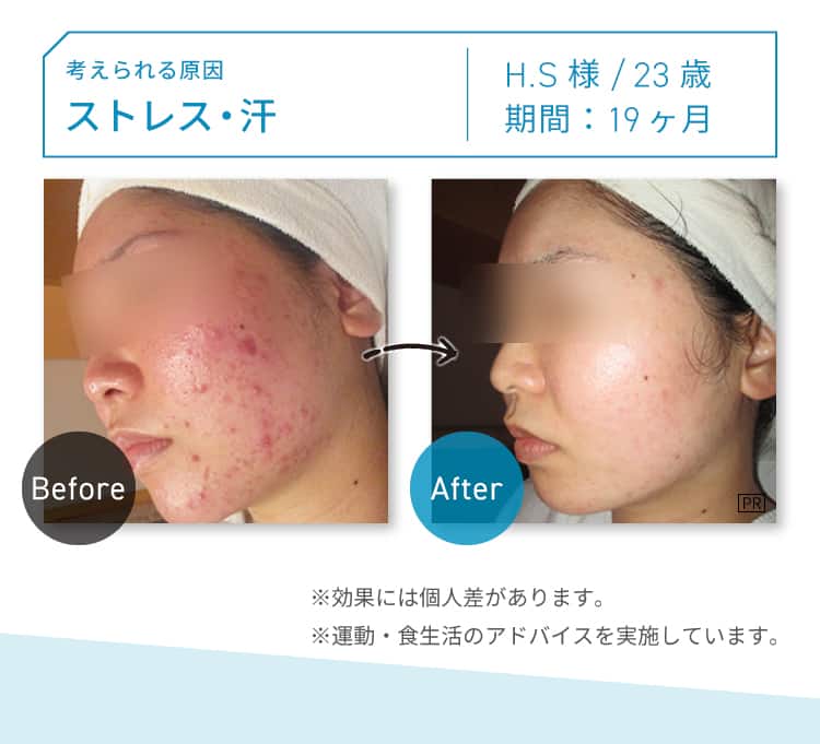 CASE05 考えられる原因：ストレス・汗 H.S様 23歳 期間：約19ヶ月 Before-After