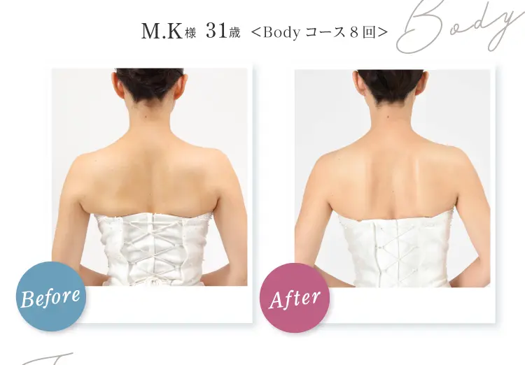 Body M.K様 31歳 Before After Body コース8回 首筋から背中がスッキリ!天使の羽根もしっかり見える状態に