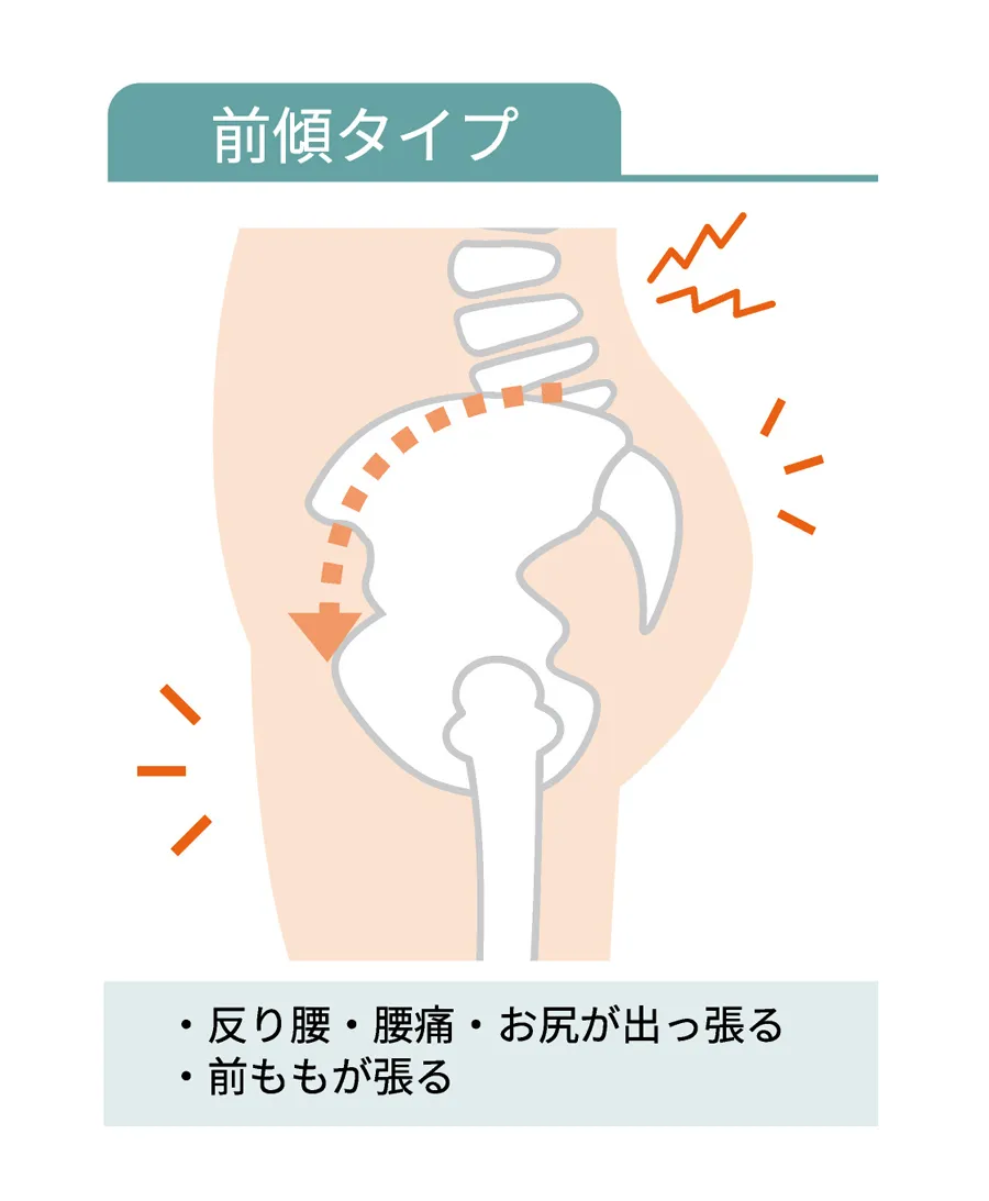骨盤・前傾タイプ