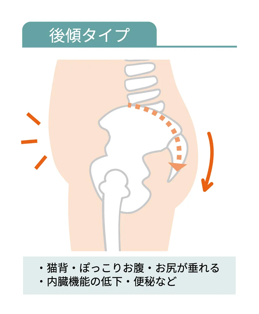 骨盤・後傾タイプ