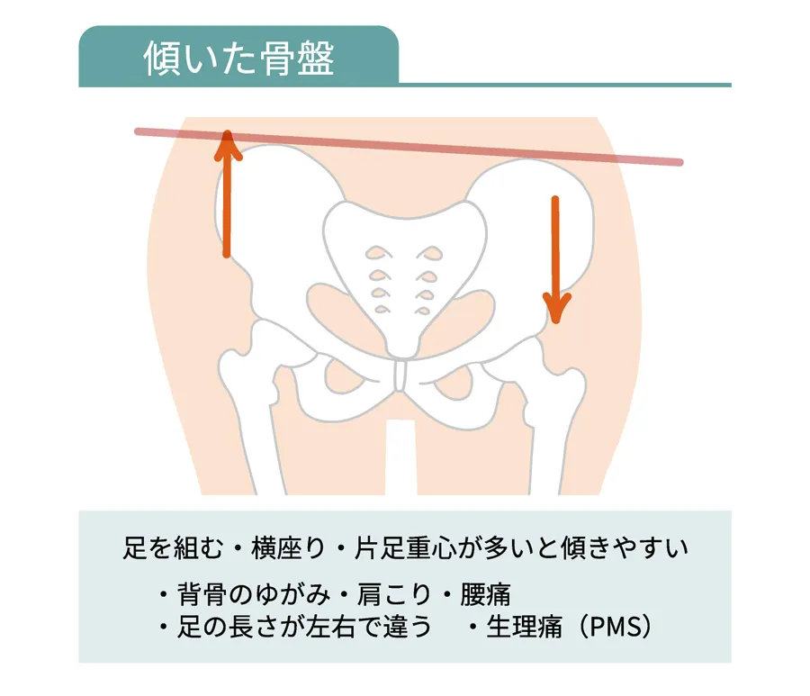 左右が傾いた骨盤