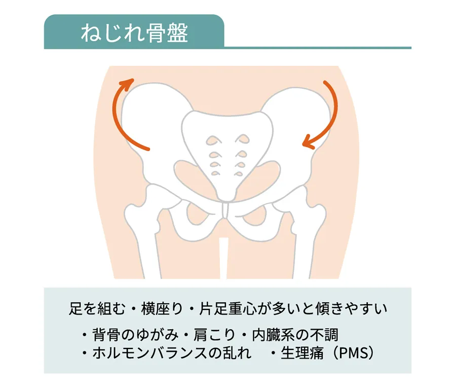 ねじれた骨盤