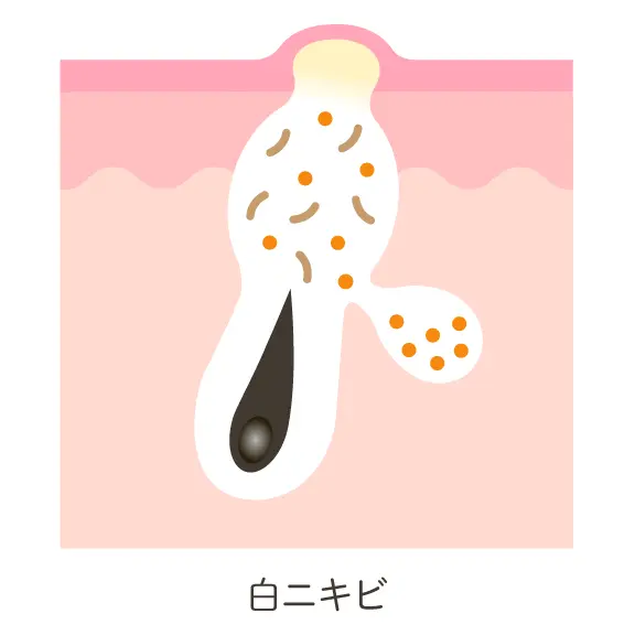 白ニキビの状態