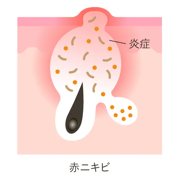 赤ニキビの状態
