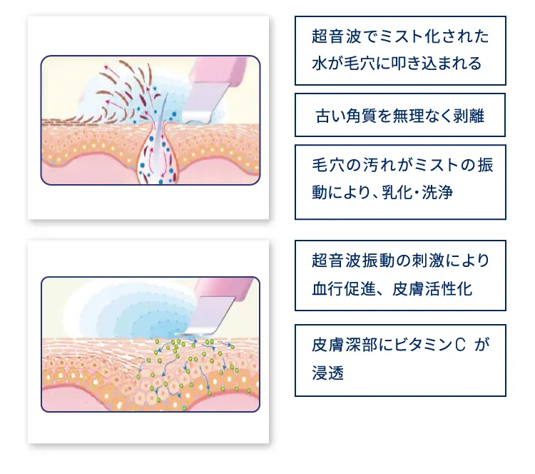 超音波でミスト化された水が毛穴に叩き込まれる
        古い角質を無理なく剥離
        毛穴の汚れがミストの振動により、乳化・洗浄
        超音波振動の刺激により血行促進、皮膚活性化
        皮膚深部にビタミンCが浸透