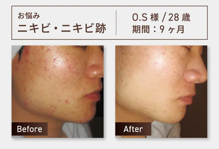 お悩み：ニキビ・ニキビ跡 O.S様 28歳 期間約9ヶ月 Before-After