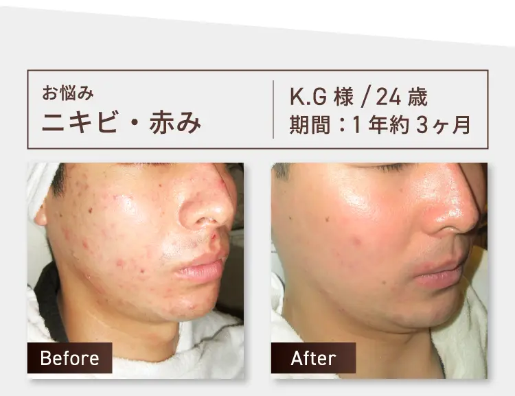 お悩み：ニキビ・赤み K.G様 24歳 期間約1年3ヶ月 Before-After