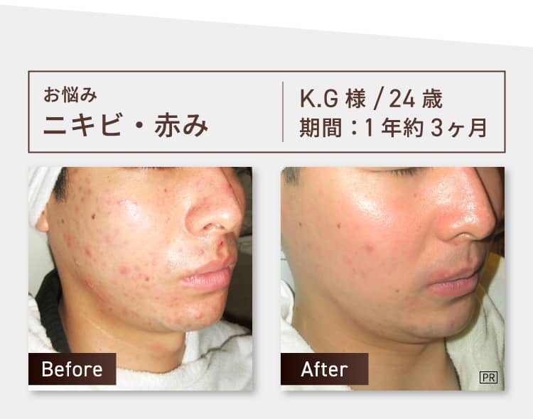 お悩み：ニキビ・赤み K.G様 24歳 期間約1年3ヶ月 Before-After