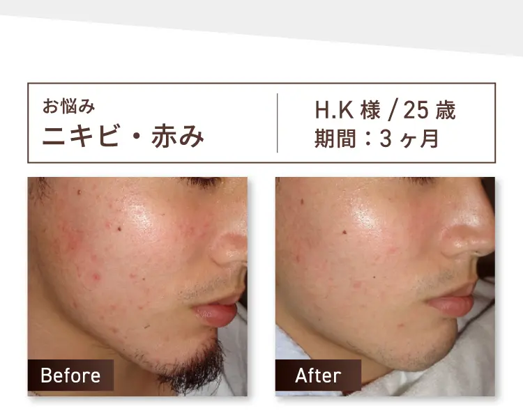 お悩み：ニキビ・赤み H.K様 25歳 期間約3ヶ月 Before-After