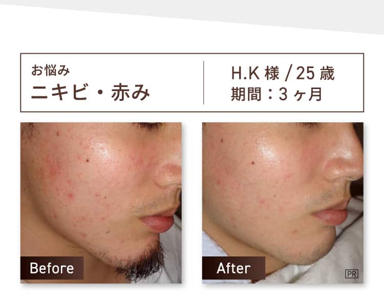 お悩み：ニキビ・赤み H.K様 25歳 期間約3ヶ月 Before-After