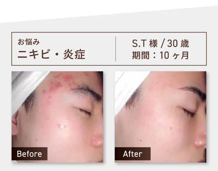 お悩み：ニキビ・炎症 S.T様 30歳 期間約10ヶ月 Before-After