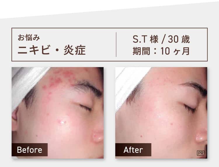 お悩み：ニキビ・炎症 S.T様 30歳 期間約10ヶ月 Before-After
