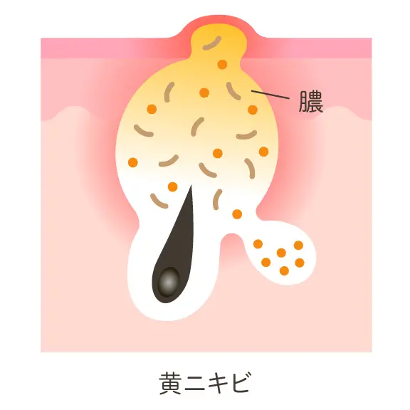 黄ニキビの状態