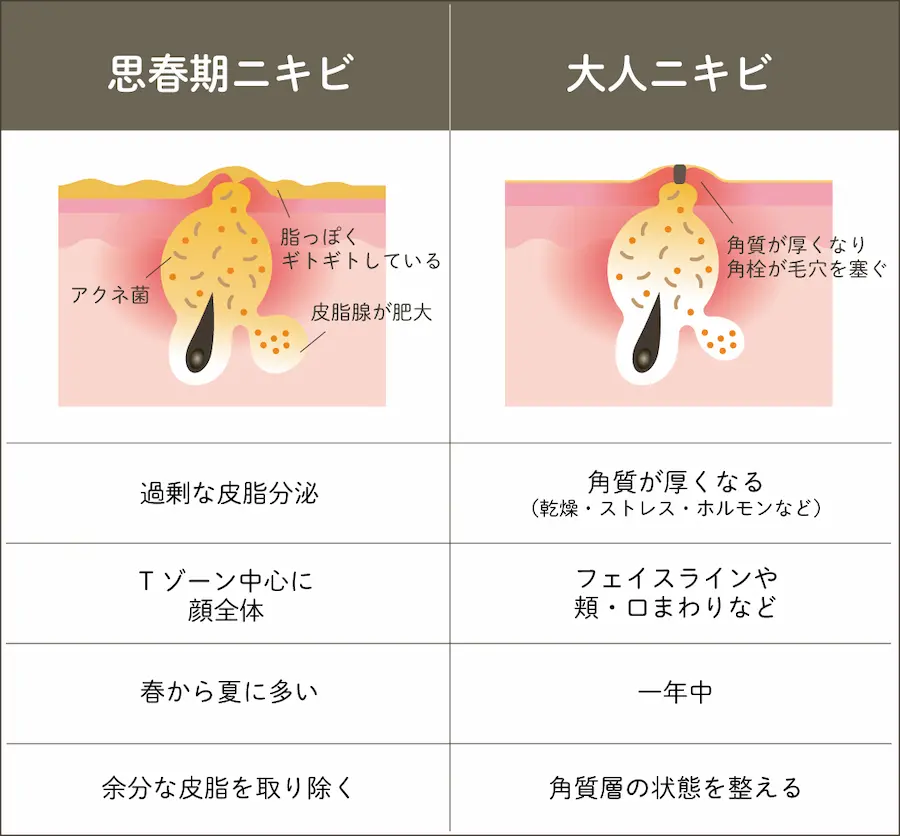 思春期ニキビと大人ニキビの違い